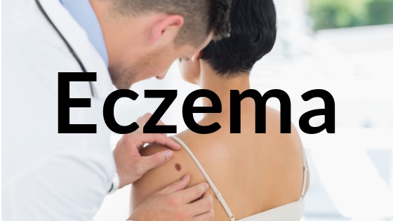 Eczema | Atopic dermatitis